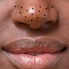 the_pimples